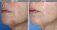 Chicago Laser Skin Rejuvenation